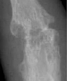 Closeup of bone erosions in rheumatoid arthritis X-ray of right fourth PIP joint with bone erosions by rheumatoid arthritis.jpg