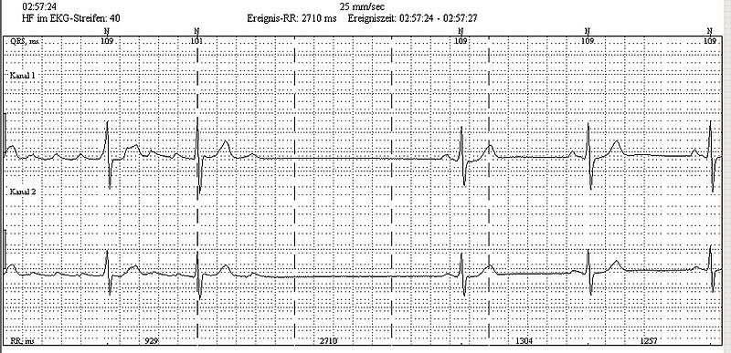 File:Holter AtrialFlutter.jpg