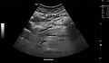 Identifying pancreas on abdominal ultrasonography when it is partly obscured by bowel gas.
