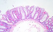 Sessile Serrated Adenoma, Transverse Colon, 0.4 cm (3632298679).jpg