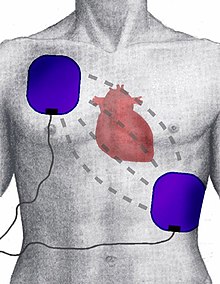 Demonstration of electrode pad placement for defibrillation. Defibrillation Electrode Position.jpg