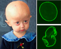 March 2: In progeria patients, the cell nucleus has dramatically aberrant morphology (bottom, right) rather than the uniform shape typically found in healthy individuals (top, right).