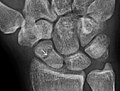 Radiolucency around a 12 days old scaphoid fracture that was initially barely visible.[13]