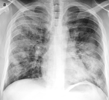 X-ray of bronchopneumonia: multifocal lung consolidation bilaterally. X-ray of bronchopneumonia.png