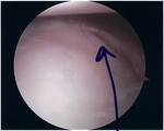 Scheur in het kraakbeen, zichtbaar tijdens een kijkoperatie