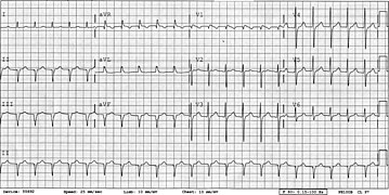 EKG bei AV-Knoten-Reentrytachykardie