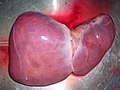 Miniatura para Trasplante de hígado