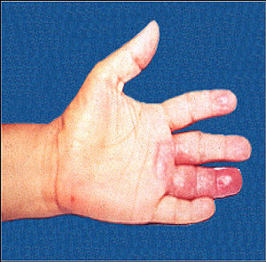 Leprosy hand affected fourth digit