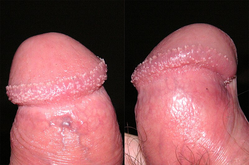 Most likely you have pearly penile papules These are small white or 