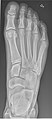 Normal right foot by dorsoplantar projection