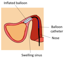 The working principle of balloon sinuplasty. A balloon catheter is inserted into the swelling sinus and inflated, which enables reopening of the sinus passage. Balloon sinuplasty 3.png
