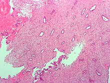 Low magnification micrograph of decidualized endometrium. H&E stain Endometrium ocp use0.jpg