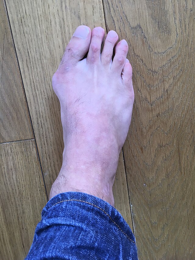 Description de l'image Halluxvalgus.jpg.