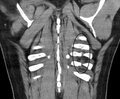 Fracture de côte sur un scanner thoracique