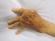 Rheumatoid Arthritis.JPG