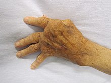 Joints of a hand swollen and deformed by rheumatoid arthritis, an autoimmune disorder Rheumatoid Arthritis.JPG