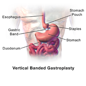 Blausen 0904 VerticalBandedGastroplasty.png