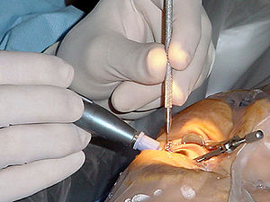 Cataract surgery, using a temporal approach ph...