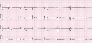 EKG ukazující sinusovou bradykardii při 43 bpm. Obrázek je tvořen červenou mřížkou na bílém pozadí. Černá čára sleduje srdeční rytmus pacientů.