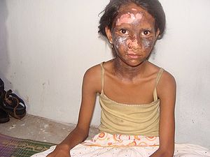 Fillette indienne chrétienne brûlée au cours des émeutes d'Orissa en août 2008.
