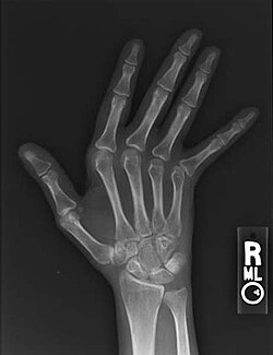 اعتلال مفصل جاكود الذي يظهر على يد الأشعة السينية على عكس اعتلال المفاصل بسبب التهاب المفاصل الروماتويدي، لا توجد تآكل.
