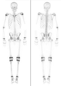 Skelettszintigrafien bei zwei Kindern, links 7 Jahre, rechts 15 Jahre alt (nicht maßstabsgerecht). Jeweils intensiver Knochenstoffwechsel in den Wachstumsfugen.