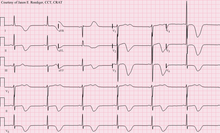 12-lead ECG of a patient with stroke, showing large deeply inverted T-waves. Various ECG changes may occur in people with stroke and other brain disorders. Left MCA Stroke.png