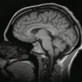 Schnitt durch den Kopf eines Menschen, Die Nase befindet sich links; Animierte Version mehrerer sagittaler Schnittebenen