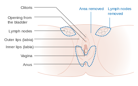 Una vulvectomia parcial de la zona inferior de la vulva