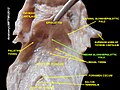 Median glossoepiglottic fold