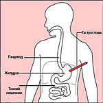 Гастростомия26 апреля 2012