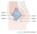 anterior operation시에 절제되는 구역을 나타낸 그림