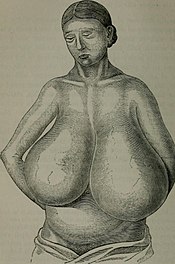 Hypertrophy of breast 2.jpg
