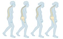 Bone mineral density, especially of the vertebrae, decreases with menopause. Menopause - Osteoporosis -- Smart-Servier (cropped).jpg