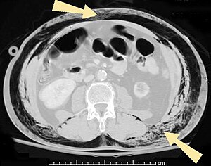 Subcutaneous emphysema abdomen arrows2.jpg