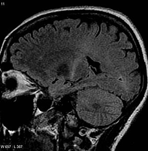 English: Amyotrophic lateral sclerosis MRI (pa...