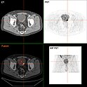 Blasenkrebs in der FDG PET/CT Darstellung