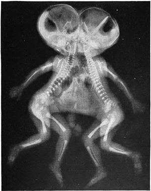 Conjoined X-ray.jpg