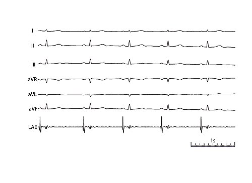 Left atrial deflection, with bipolar esophageal electrode in left atrial position using Butterworth highpass filtering.