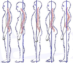 Posture types (vertebral column) classificatio...