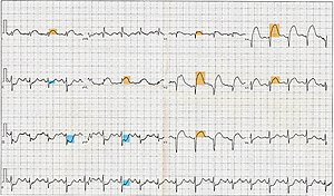 12 Lead ECG EKG showing ST Elevation (STEMI), ...