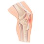 Miniatura para Tendinitis rotuliana