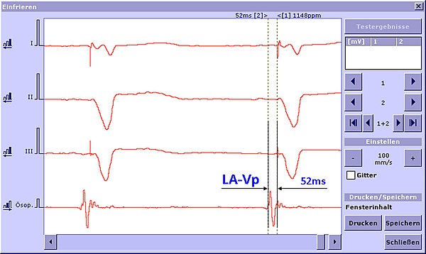 AV-Delay Optimierung 2