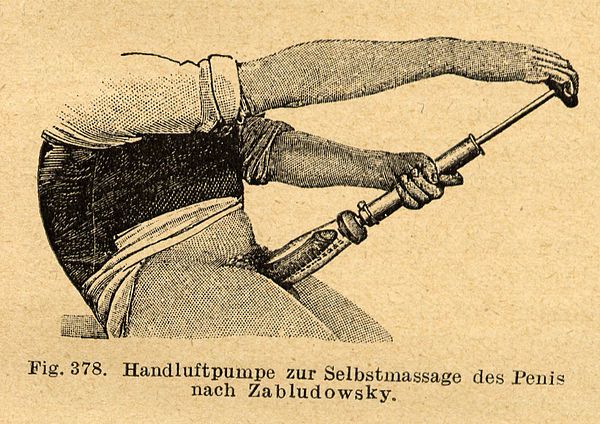 19th century Penis pump. From the book: Albert Moll, Handbuch der Sexualwissenschaften, Verlag Von F.C. Vogel, Leipzig 1921