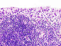 Histologický snímek zánětlivého ložiska revmatoidní artritidy