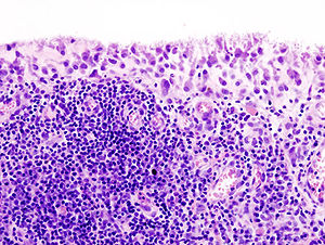 Rheumatoid arthritis (2)