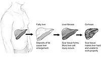 Differrent stages of liver damage due to :en:s...