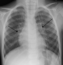 X-ray of a child with RSV bronchiolitis showing the typical bilateral perihilar fullness RSV.PNG