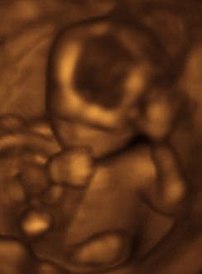 A 3D ultrasound taken of a fetus at 17 weeks.