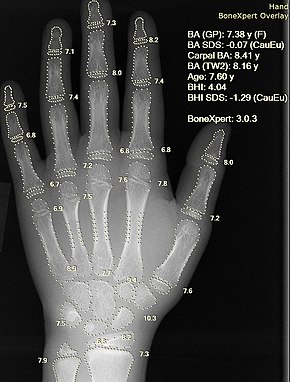 Рентген руки, на котором костный возраст автоматически определяется программой BoneXpert.jpg